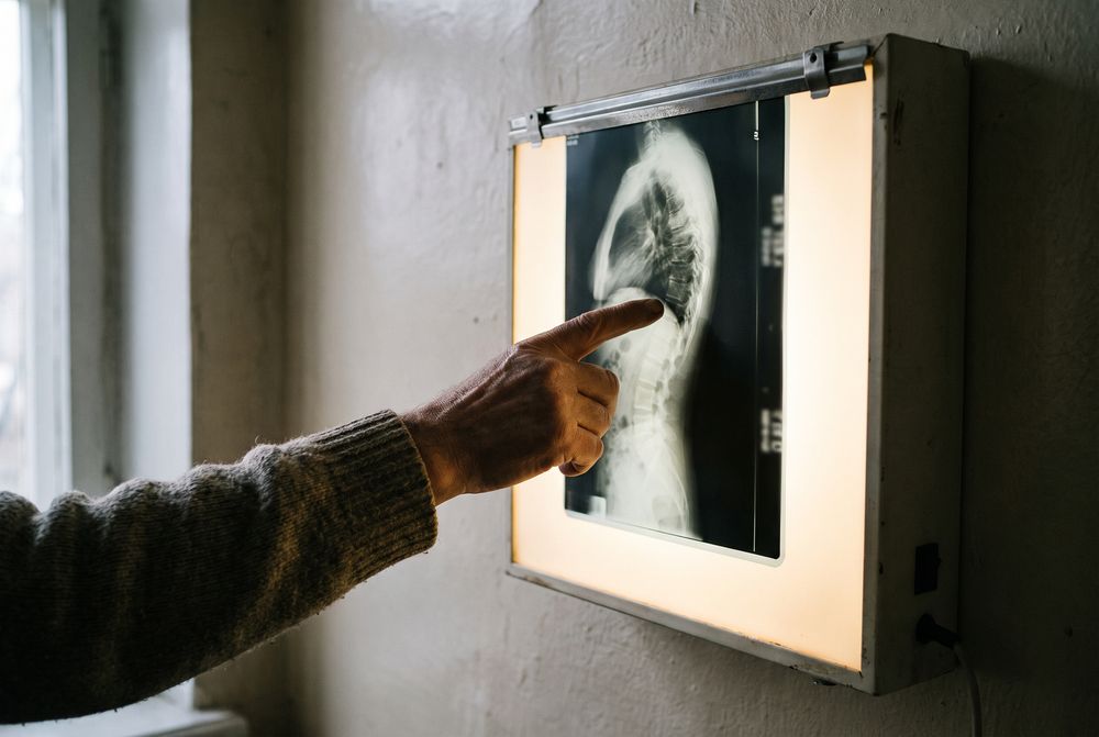 subluxation xray review thornton